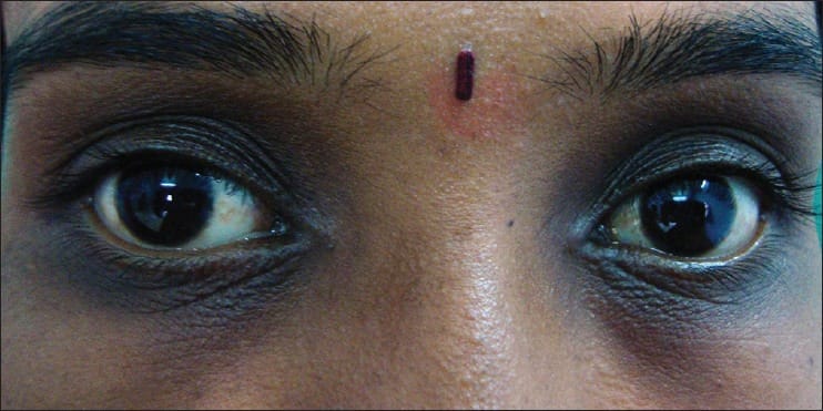 Как избавиться от тёмных кругов под глазами