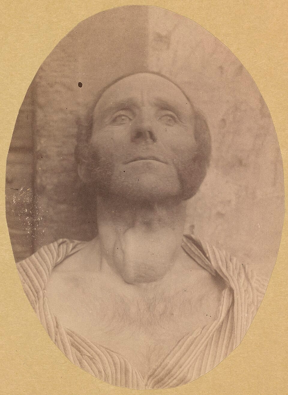 Волосы выпадают? Проверь щитовидную железу